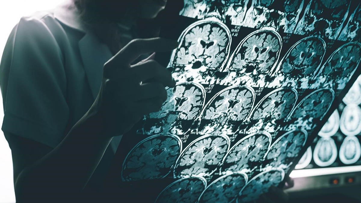 Avances en la Cura del Alzheimer【Nuevos Tratamientos y Terapias Innovadoras】